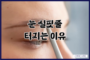 눈 실핏줄 터짐 주요 원인과 예방법 알아보기