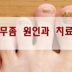 발톱무좀 없애는 방법, 원인은 이거다 다이어트 식단 미용